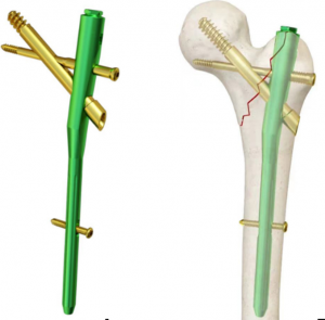 Proximal Femoral Nail