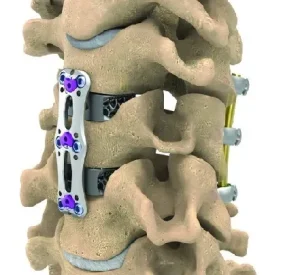 Cervical Plate Manufacturer